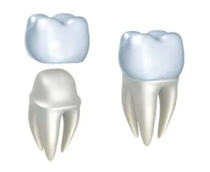 drawing of how Steven P Ellinwood DDS in Fort Wayne IN fits dental crowns over existing teeth