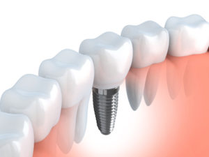 3D graphic of dental implants treatment that you can receive at Steven P Ellinwood DDS in Fort Wayne IN